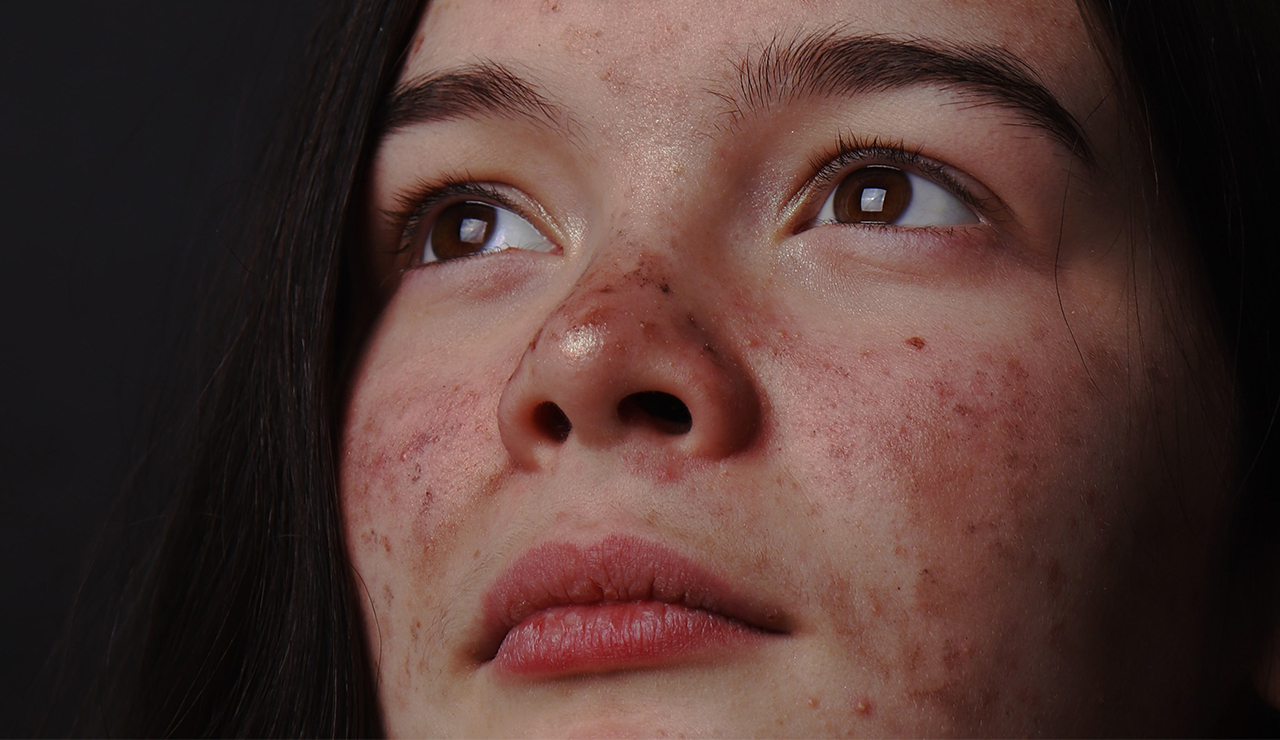 El acné: Tipos, síntomas y tratamientos